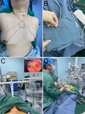 Gasless endoscopic thyroidectomy via modified areola approach with a simple flap-lifting technique